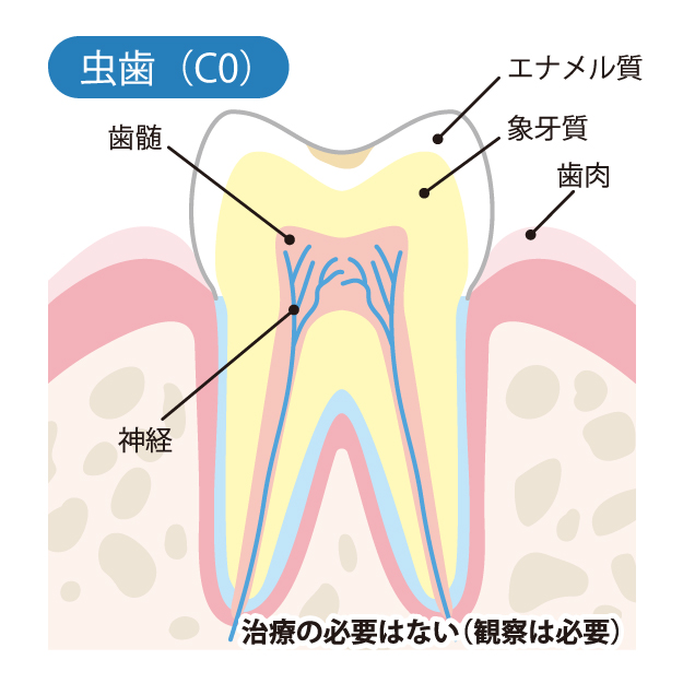 かほく市の歯医者、しん義歯科口腔外科で虫歯治療