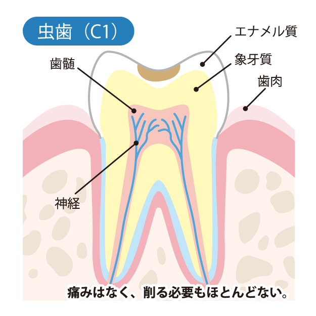 かほく市の歯医者、しん義歯科口腔外科で虫歯治療