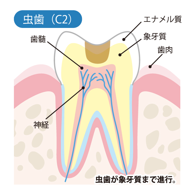 かほく市の歯医者、しん義歯科口腔外科で虫歯治療