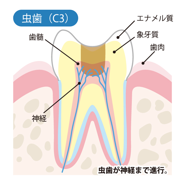 かほく市の歯医者、しん義歯科口腔外科で虫歯治療