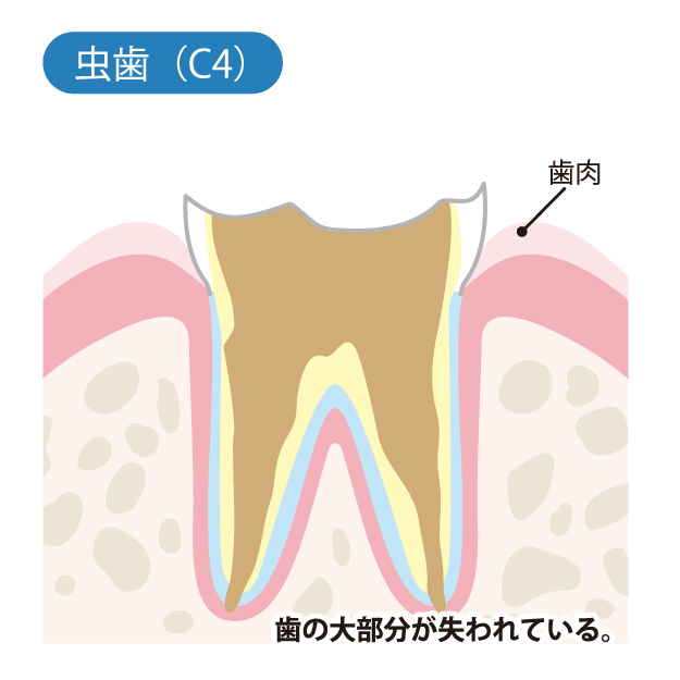 かほく市の歯医者、しん義歯科口腔外科で虫歯治療