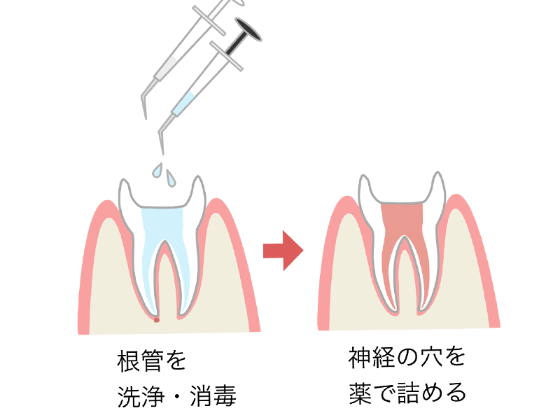 かほく市の歯医者、しん義歯科口腔外科の根管治療
