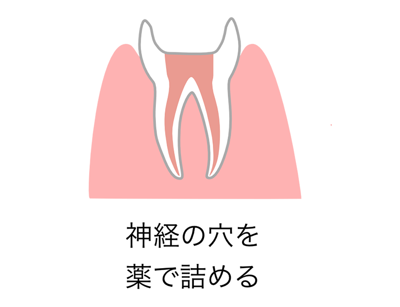 かほく市の歯医者、しん義歯科口腔外科の根管治療